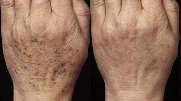 Hand Rejuvenation New York
