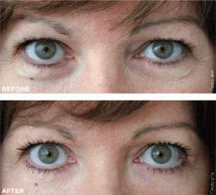 eye rejuvenation new york