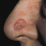 skin-cancer-3