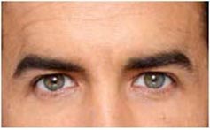 Man's Eyes After Photo, BOTOX, New York Man's Eyes After Photo, BOTOX, New York - Michele S. Green, M.D.