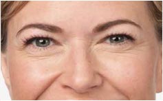 Blonde Woman Crows Feet Photo Before BOTOX, New York Blonde Woman Crows Feet Photo Before BOTOX, New York - Michele S. Green, M.D.