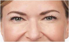 Blonde Woman Crows Feet Photo After BOTOX, New York Blonde Woman Crows Feet Photo After BOTOX, New York - Michele S. Green, M.D.