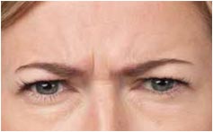 Blonde Woman Frown Lines Before Photo BOTOX, New York Blonde Woman Frown Lines Before Photo BOTOX, New York - Michele S. Green, M.D.