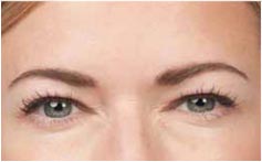 Blonde Woman Frown Lines After Photo BOTOX, New York Blonde Woman Frown Lines After Photo BOTOX, New York - Michele S. Green, M.D.