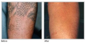 Tattoo Removal New York City NYC