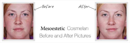 Before And After Images, Blonde Female Mesotestetic Cosmelan, New York Before And After Images, Blonde Female Mesotestetic Cosmelan, New York - Michele S. Green, M.D.