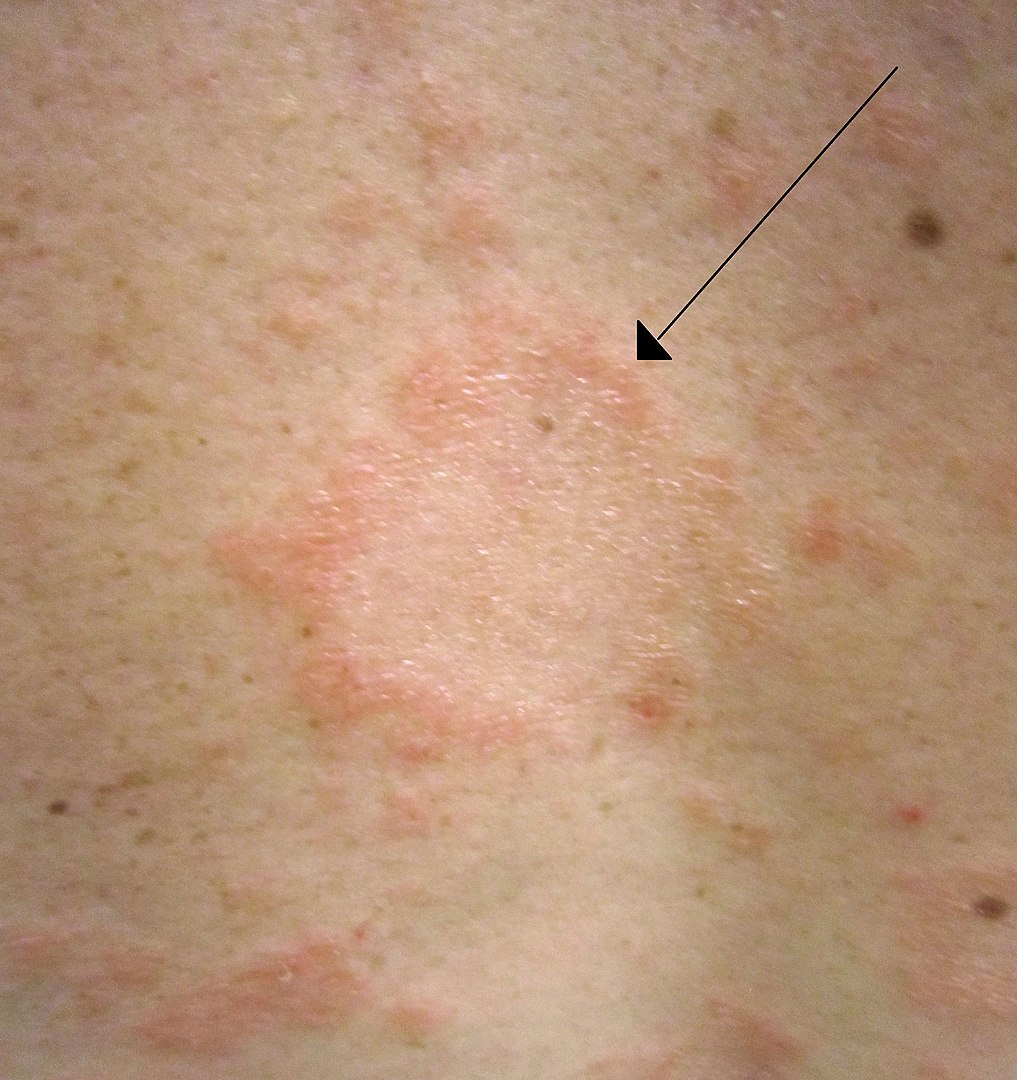 Pityriasis discount rosea treatment