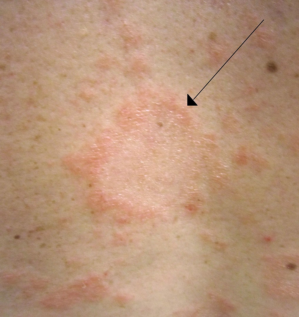 Pityriasis Rosea Treatment NYC - What is Pityriasis Rosea?