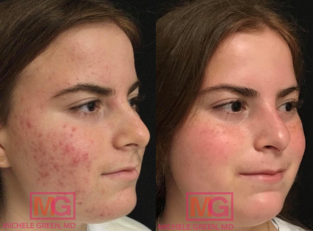 16 year old, Accutane 6 months