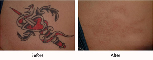 laser tattoo removal nyc tattoo removals laser tattoo removal nyc tattoo removals