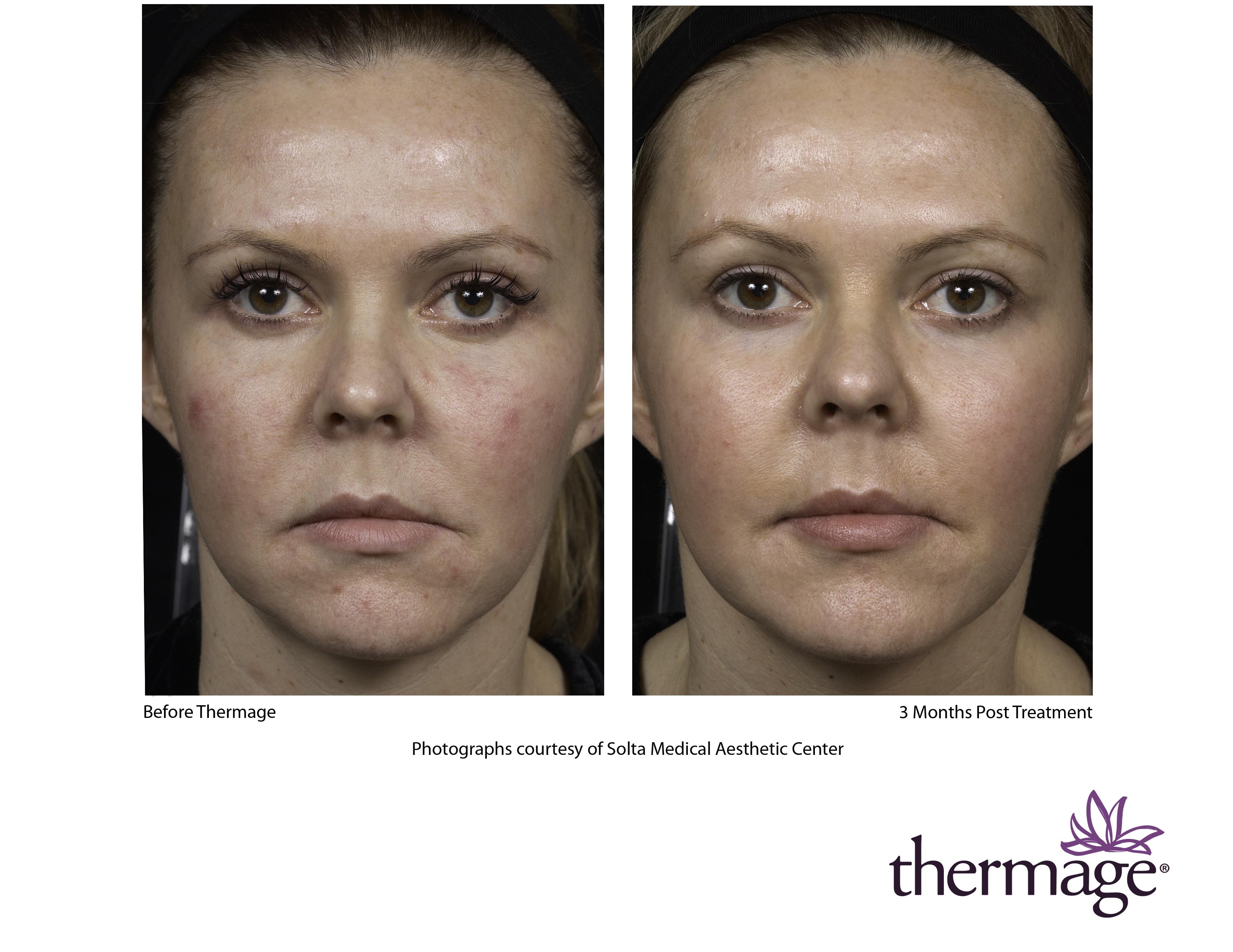 Thermage For Eyes Before And After