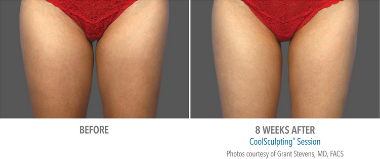 coolsculpting thighs inner results outer thigh treatment slimming sculpting solution disclaimer vary patient each
