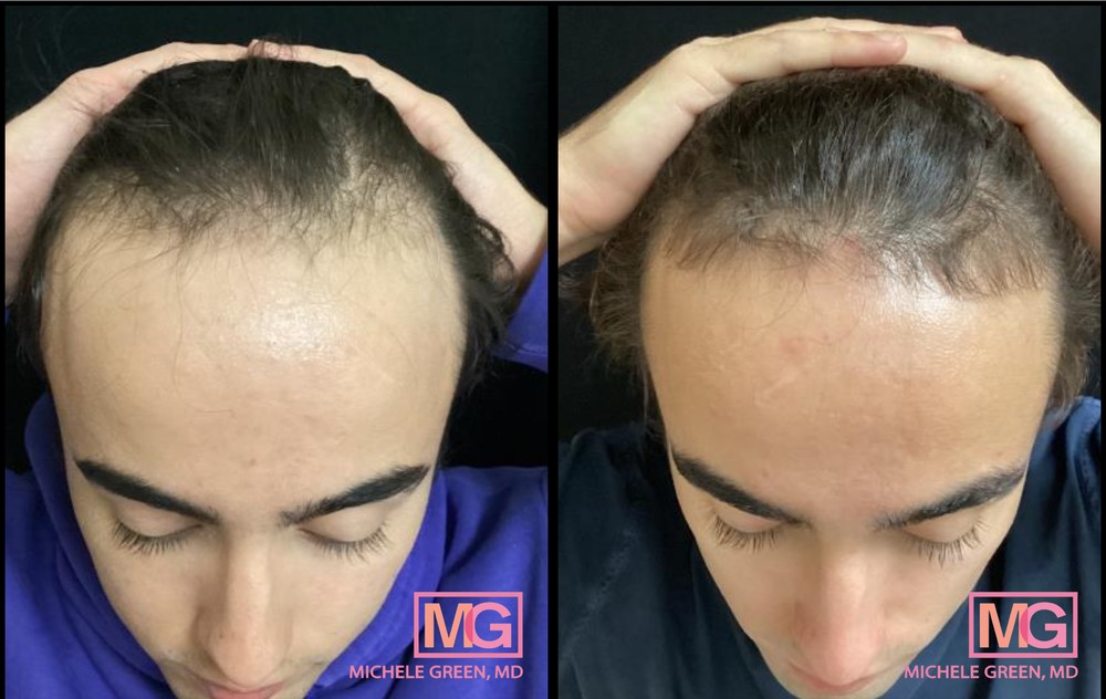 21 Year Old Male Before and After Hair PRP Treatment