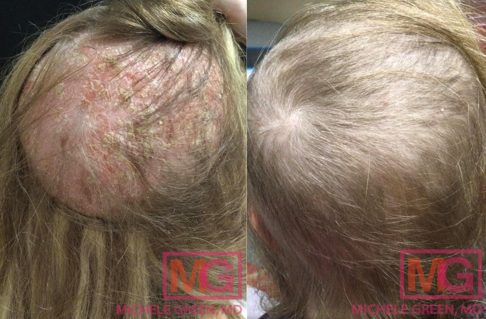 22 yo female before and after two sessions of PRP MGWatermark 1
