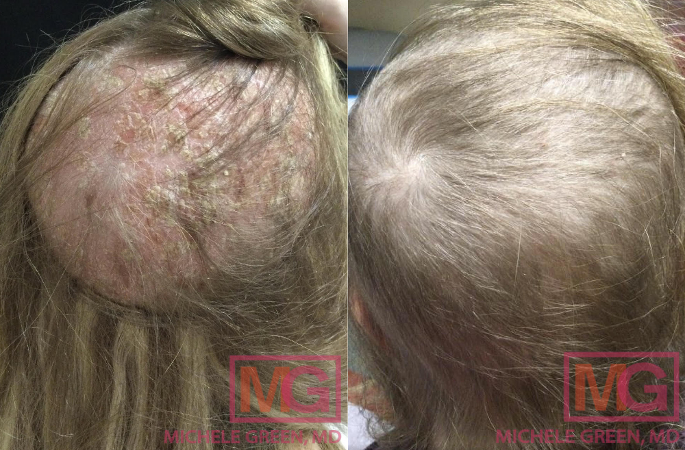 22 year old female before and after two sessions of PRP