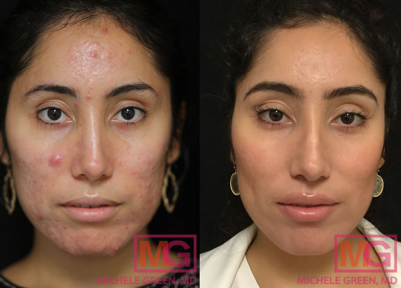 Accutane Treatment for Acne - Dr. Michele Green M.D.