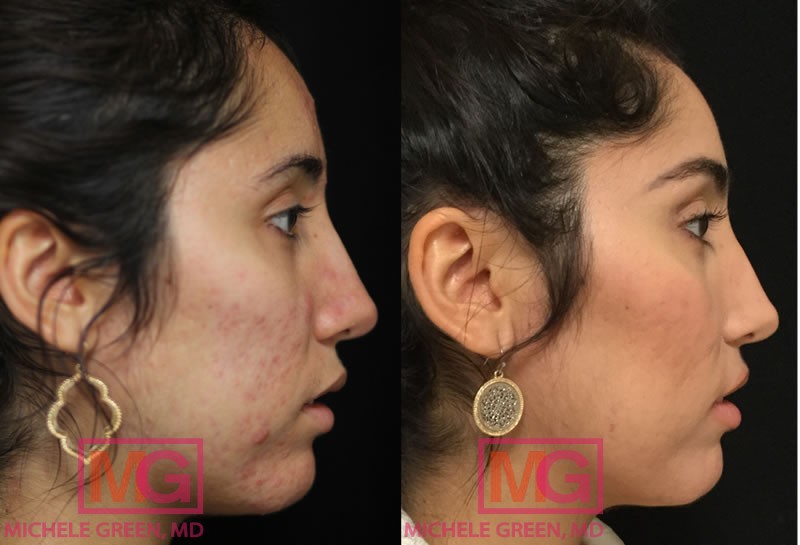 Female 23 years old, 3 months before and after Accutane