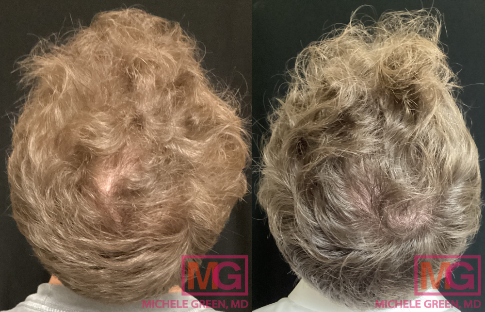 23yo male hair loss MGWatermark