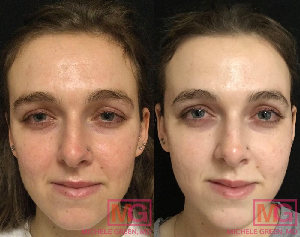 24 yo F before and after 2 Sculptra 1 Restylane and 2 ematrix MGWatermark