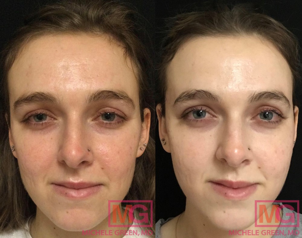 24 year old female with 2 Sculptra, 2 eMatrix and 1 Restylane injection