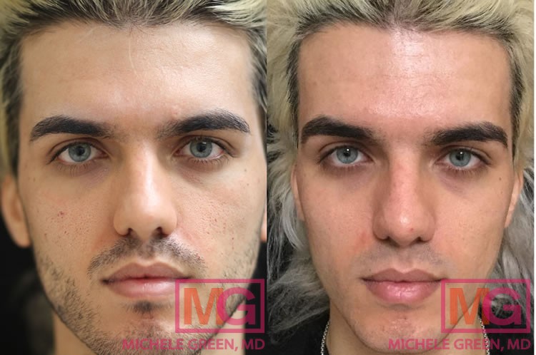 20-29 year old male, eMatrix and Restylane