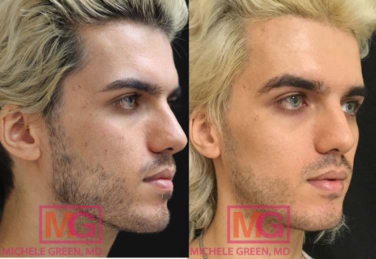 24 year old male, eMatrix and Restylane