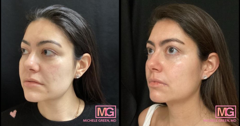 28 Year Old Female Before and After Accutane