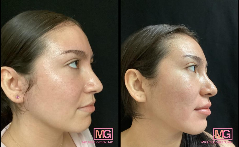 28 Year Old Female Before and After Juvederm Lip Filler