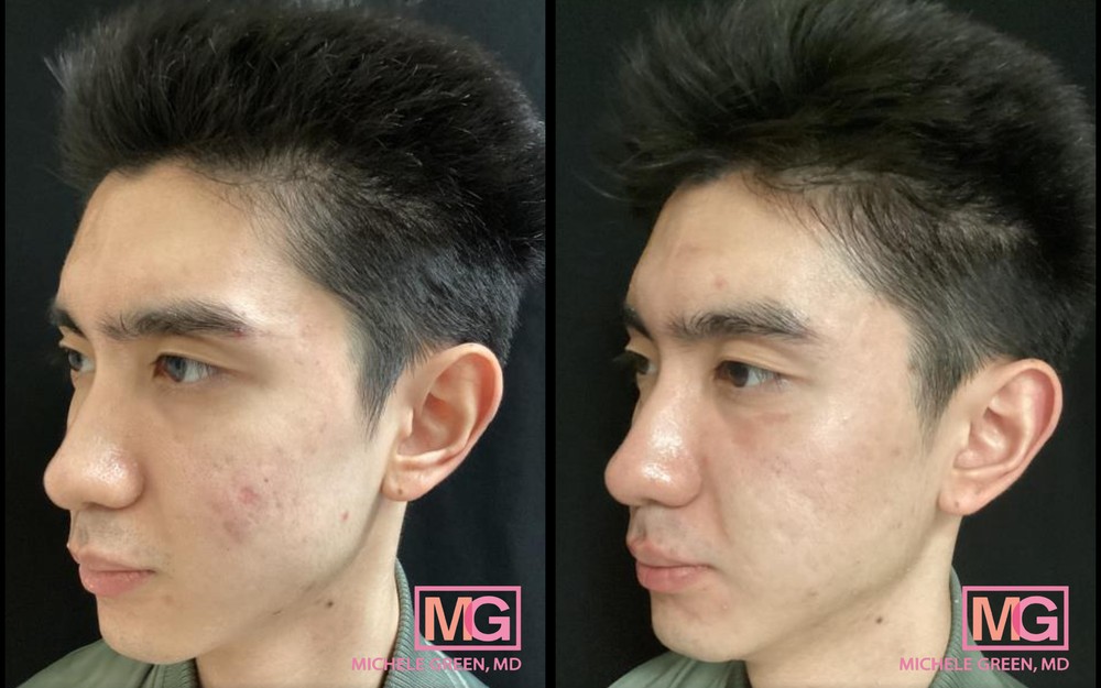 28 Year Old Male Before and After 3 Sculptra Treatments