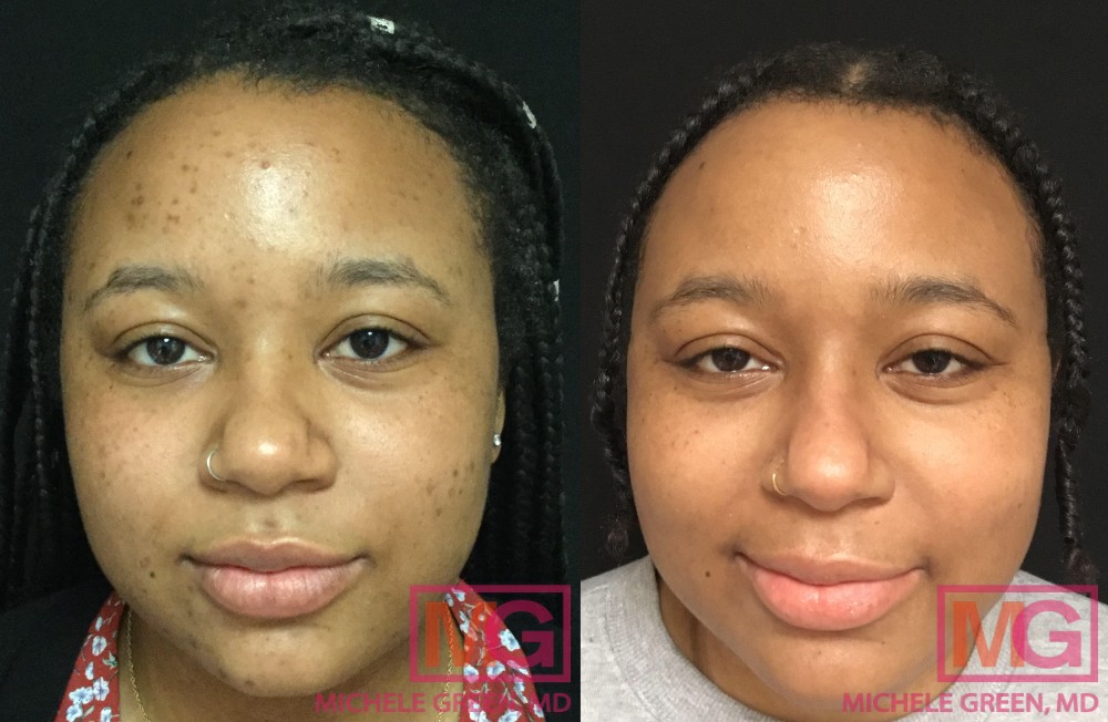 28 yr old f before after Accutane and dark acne spot treatment 7 months MGWatermark 1