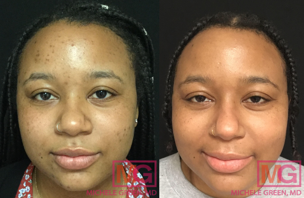 28 yr old f before after Accutane and dark acne spot treatment 7 months MGWatermark