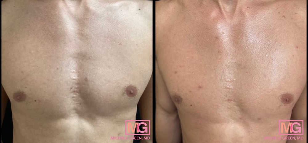 31 Year Old Male Before and After Fraxel for Acne Scarring