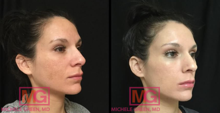 Female 25-34 Cosmelan 3 weeks post 1st in office peel