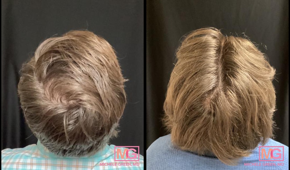 34 Year Old Male Before and After Hair PRP Treatment