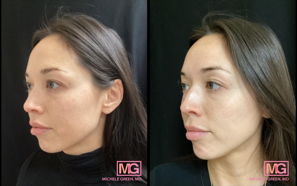 34 year old woman before and after alextrivantage
