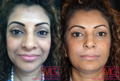35 44 female juvederm nasolabial folds before after 1 MGwatermark