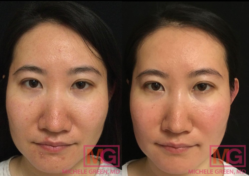 35yo Before and After Accutane 6months MGWatermark 1