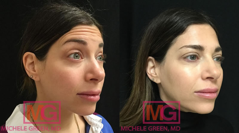 37 female botox before after ANGLER MGwatermark