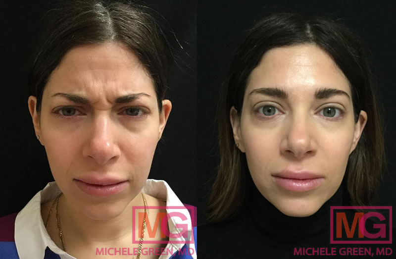 37 female botox before after FRONT