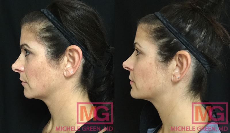 37 year old female treated with Dysport & Restylane