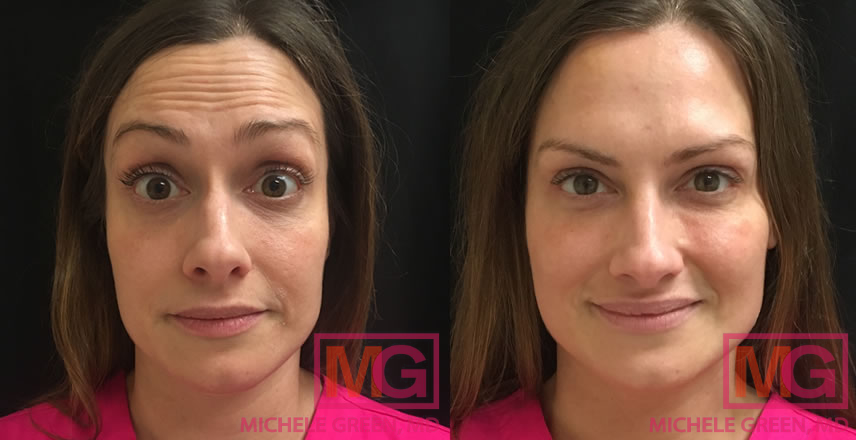 35-44 year old female treated with Botox