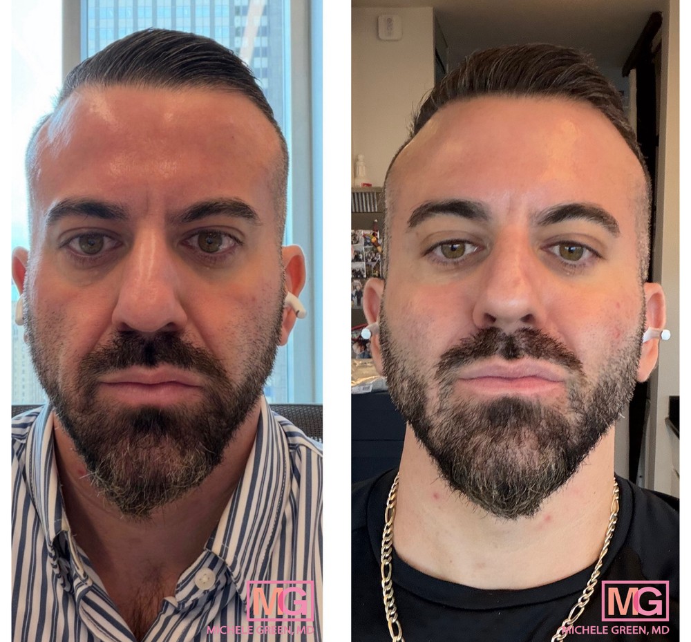 40 Year Old Male Before and After Juvederm Filler