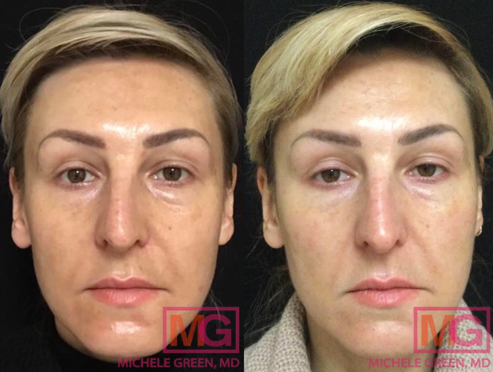 40yo female before after 2 sessions microneedling with PRP 3 months FRONT MGWatermark