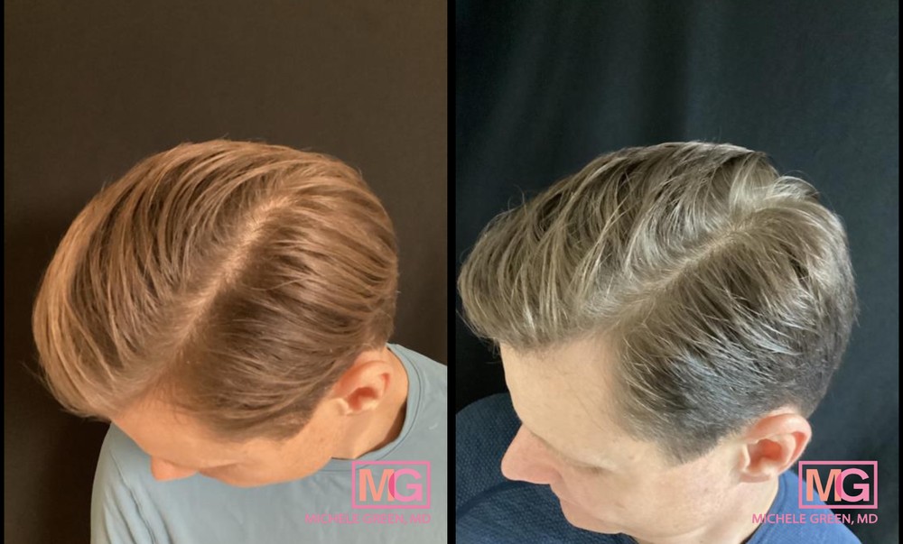 43 Year Old Male Before and After Hair PRP Treatment