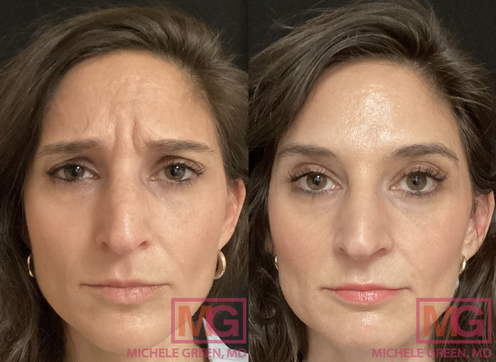 43 yo female before and after Botox 2 MGWatermark