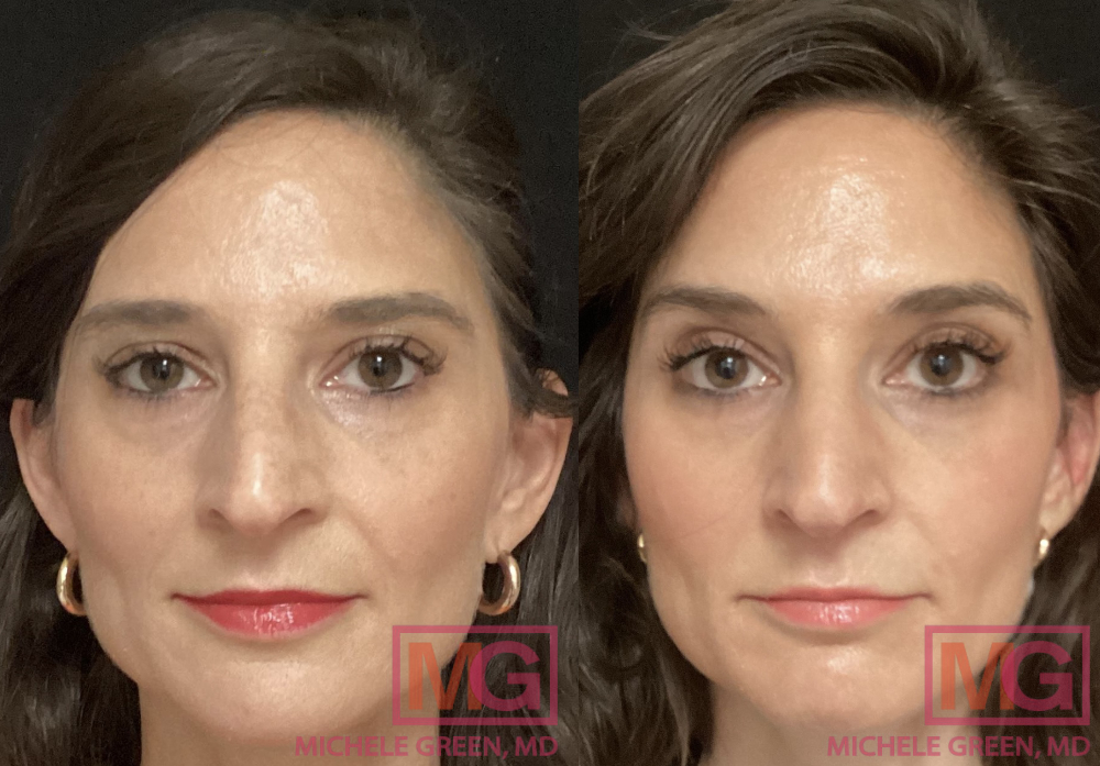 43 yo female before and after Botox 