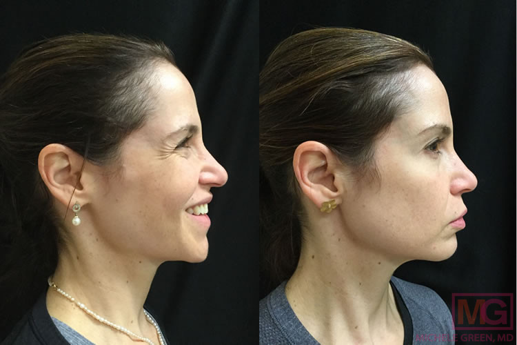 44 year old female, Botox for wrinkles around eyes