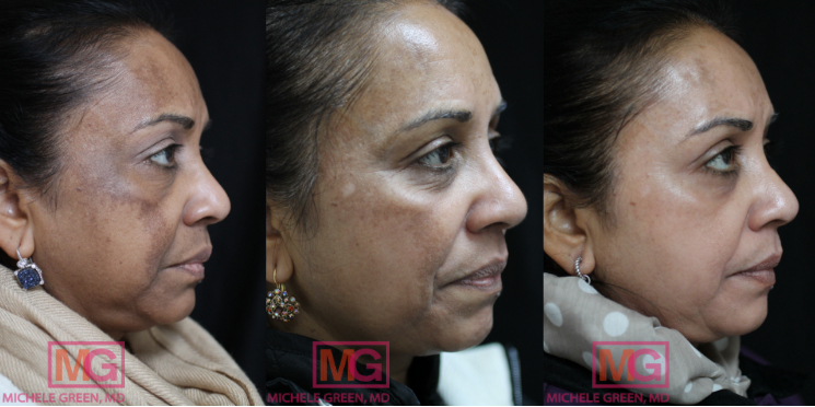 Post Laser Hyperpigmentation - Melasma & dark skin