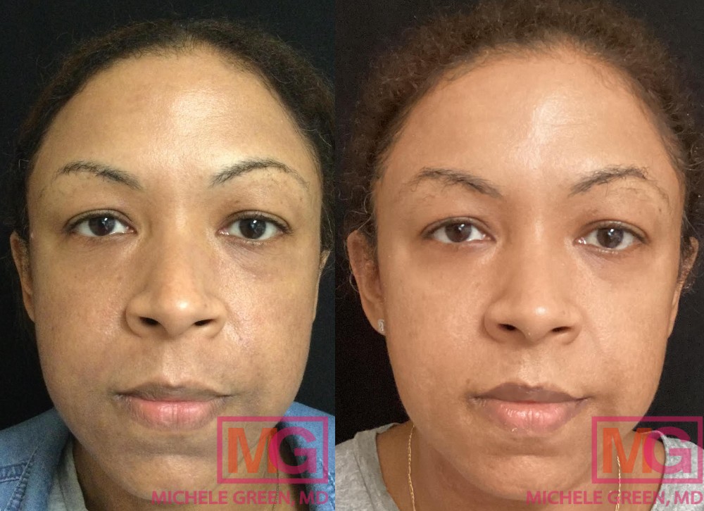 46 yo female before after Cosmelan and microneedling w depigment MGWatermark 1