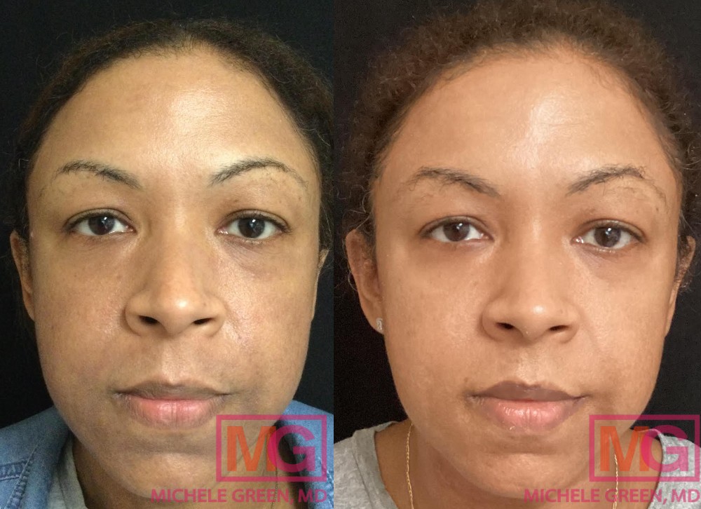 Microneedling Atlanta